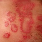 Psoriasis is a painful autoimmune condition marked by chronic formation of skin lesions, red patches, papules and plaque. 